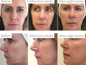 HYALURONIC ACID & PROFHILO